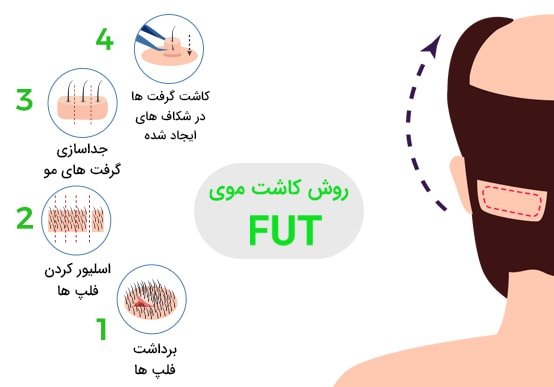 کاشت موی طبیعی به روش FUT